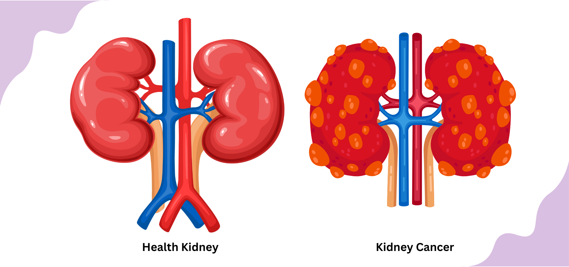 Kidney Cancer